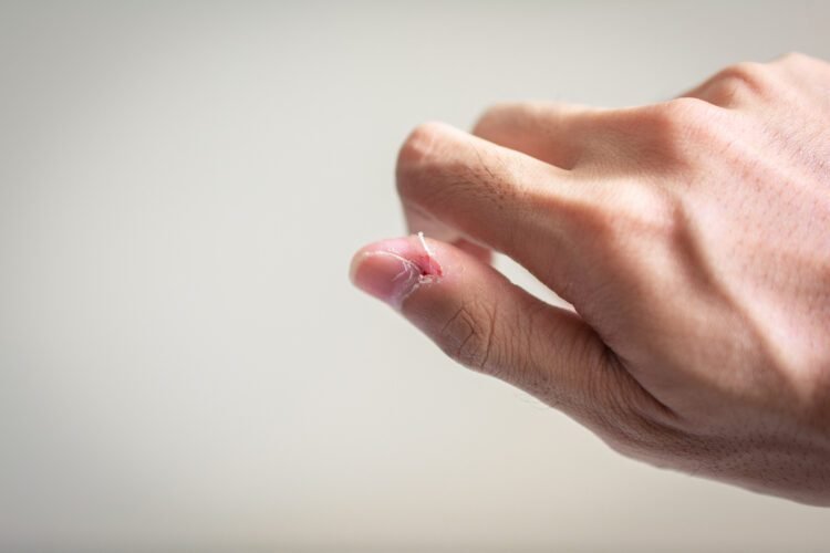 Pores and skin-picking as self-soothing: is emotion regulation the lacking piece?