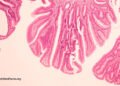 May Bovine Leukemia Virus be a Reason behind Breast Most cancers?
