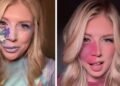Girl With Facial Birthmark Embraces Her Look