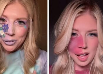 Girl With Facial Birthmark Embraces Her Look