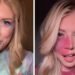 Girl With Facial Birthmark Embraces Her Look